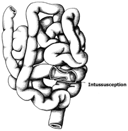 Intussusception