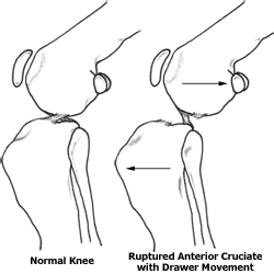 Ruptured Anterior Cruciate w/Drawer Movement